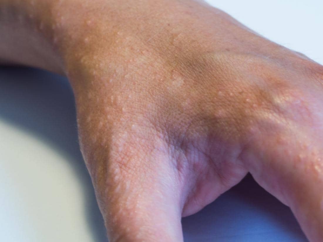 One hand is covered with small bumps caused by a sun allergy.