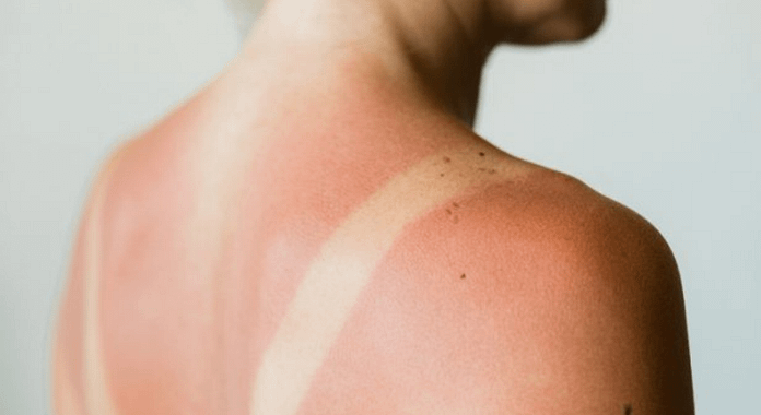 Sunburn: 9 natural tips to soothe and treat effectively

