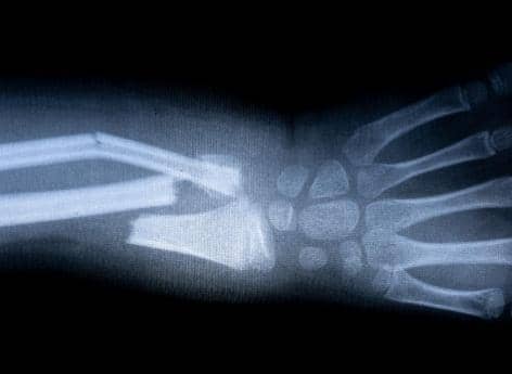 In emergency situations, French AI is greatly improving fracture management


