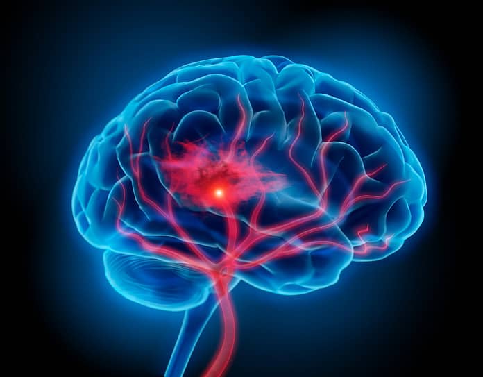 Blood-thinning drugs increase the risk of cerebral hemorrhage - medical practice

