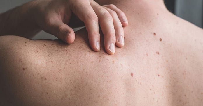 Using the ABCDE Rule: How to Check Your Body for Skin Cancer

