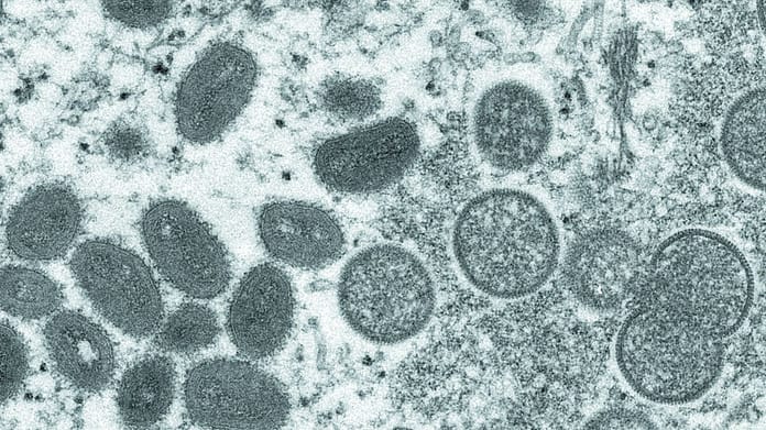 Les symptômes de la variole du singe sont similaires à ceux de la variole.