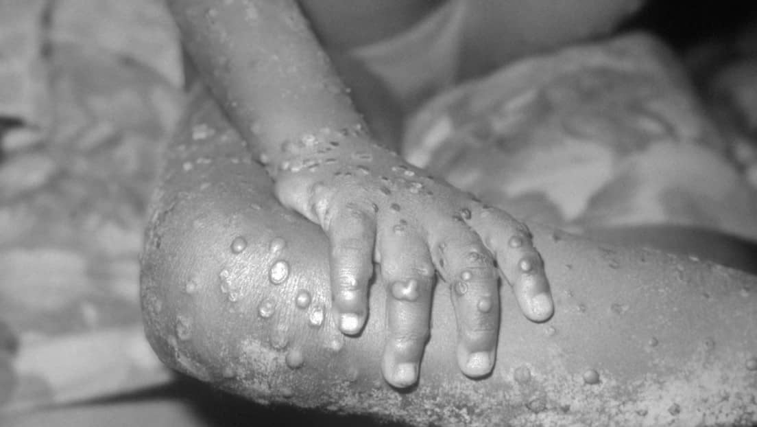 Monkeypox was first discovered in the United States since 2003